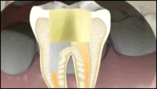Коронка на депульпированный зуб со штифтом 